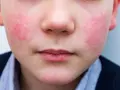 Primer plano de un niño con sarpullido alrededor de la boca y en las mejillas. La piel está enrojecida e irritada.