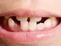 Boca de niño mostrando agenesia dental, con espacios donde faltan dientes.