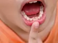 Boca de niño mostrando dientes irregulares, como dientes de tiburón en niños. Un dedo señala los dientes.
