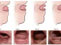 Ilustraciones y fotos de diferentes tipos de frenillo corto en bebés.