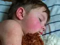 Niño durmiendo con mejillas rojas y erupción cutánea, síntomas de escarlatina en niños.