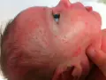 Bebé con sarpullido rojo y pequeños bultos en la cara y cabeza.
