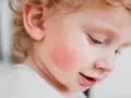 Rojo en la mejilla de un bebé, posible alergia a fruta, con síntomas visibles.