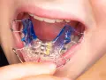 Boca de niño con aparato dental azul y transparente.