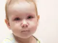 Bebé con ojos rojos e irritados, una lágrima cayendo, indicativo de conjuntivitis vírica.