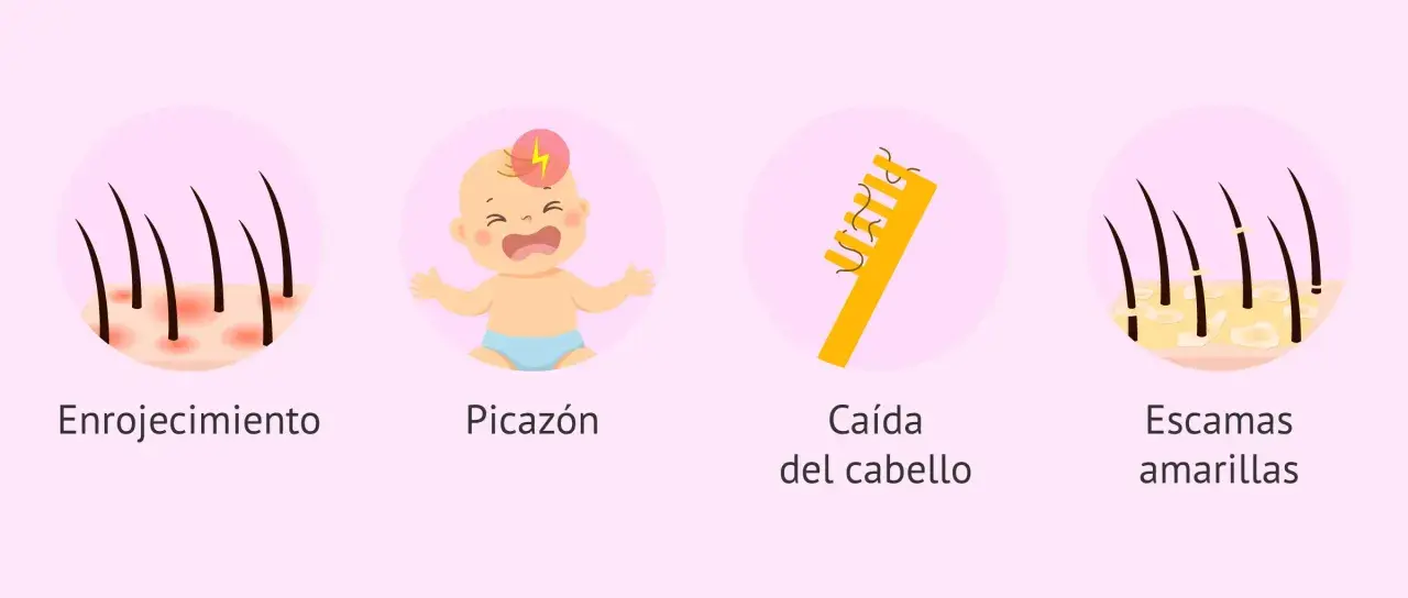 Síntomas de la costra láctea: enrojecimiento, picazón, caída del cabello y escamas amarillas.