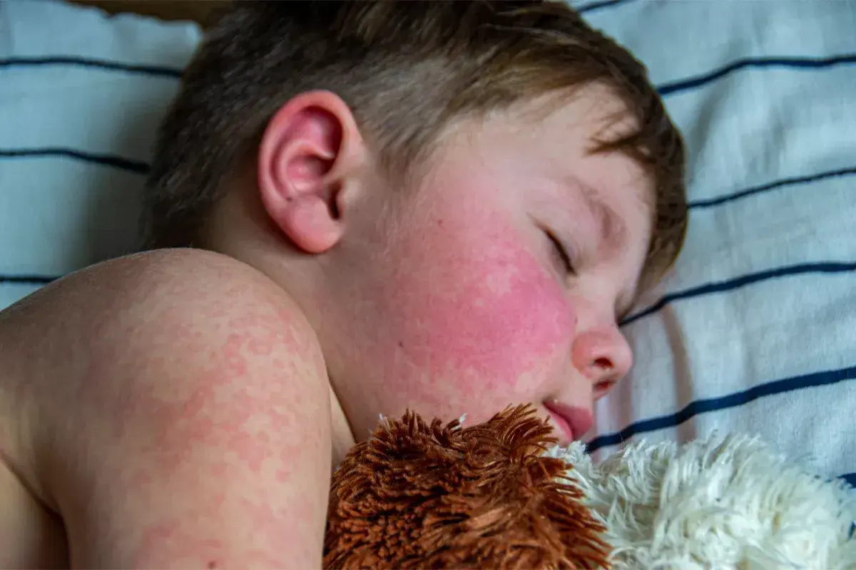 Niño durmiendo con mejillas rojas y erupción cutánea, síntomas de escarlatina en niños.