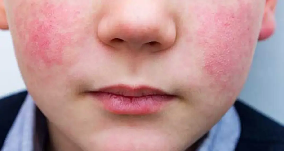 Primer plano de un niño con sarpullido alrededor de la boca y en las mejillas. La piel está enrojecida e irritada.