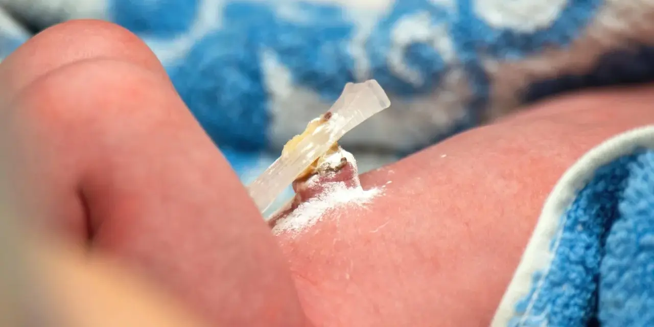 El cordón umbilical de un bebé, con un clip y polvo blanco, parece un ombligo con mal olor.