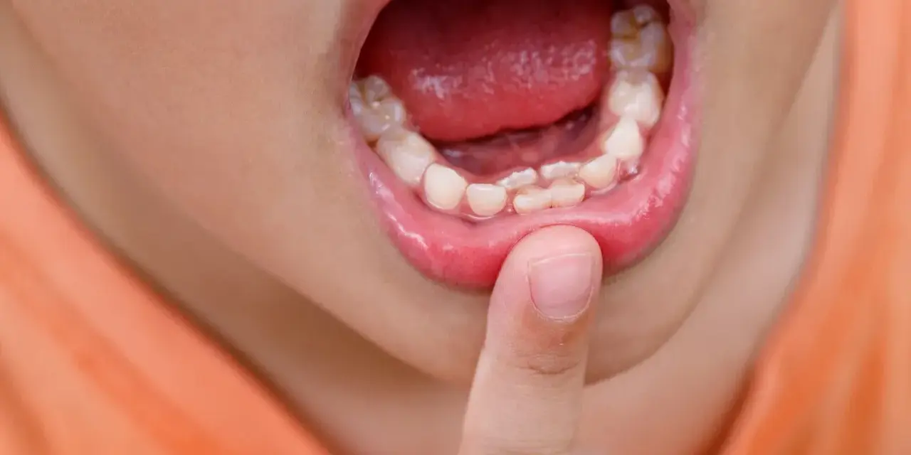Boca de niño mostrando dientes irregulares, como dientes de tiburón en niños. Un dedo señala los dientes.