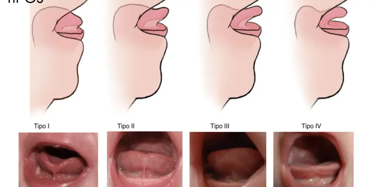 Ilustraciones y fotos de diferentes tipos de frenillo corto en bebés.