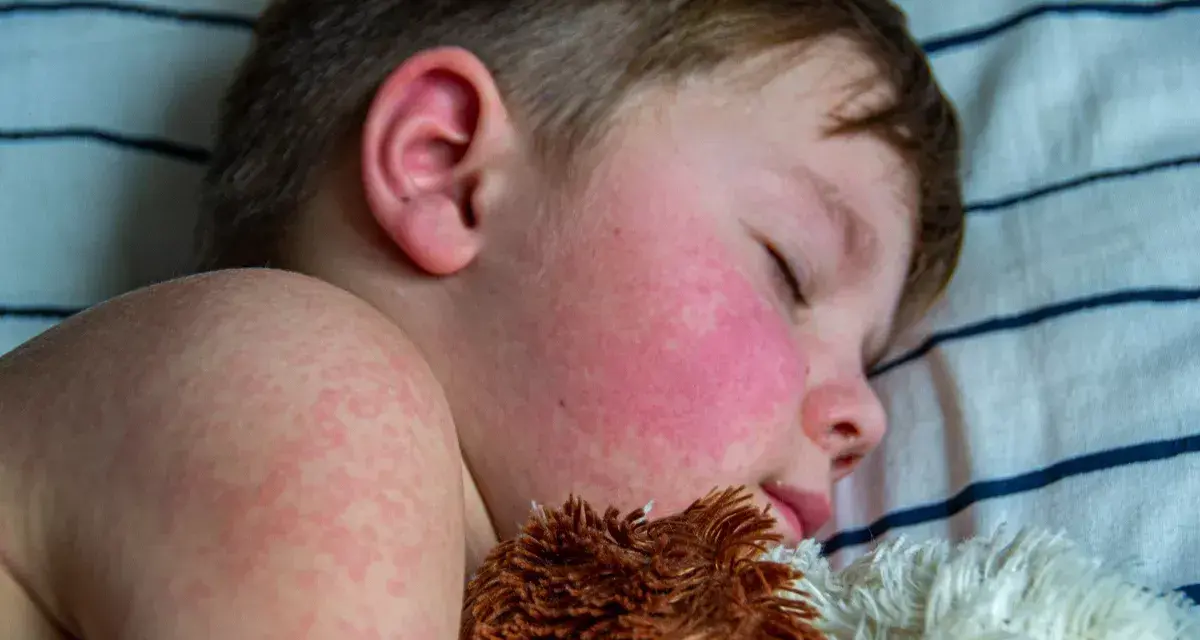 Niño durmiendo con mejillas rojas y erupción cutánea, síntomas de escarlatina en niños.