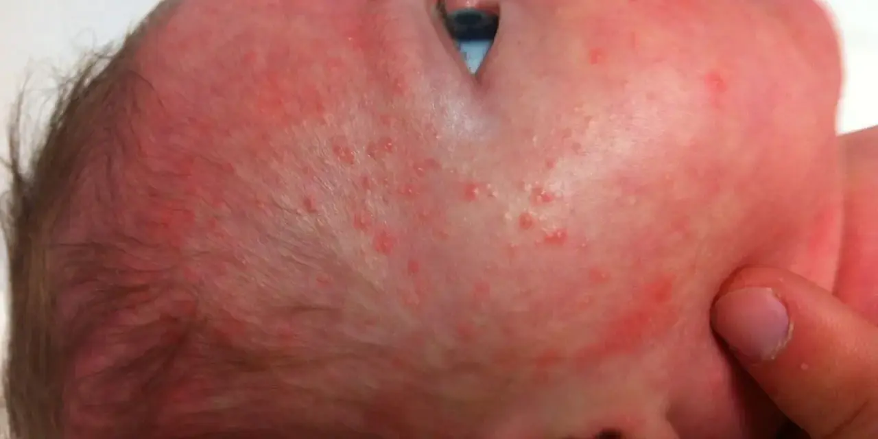 Bebé con sarpullido rojo y pequeños bultos en la cara y cabeza.