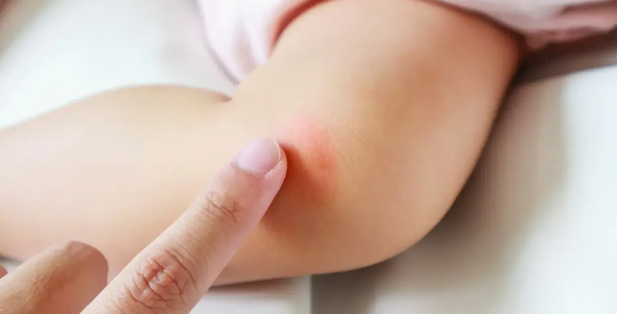Dedo señala una marca roja en el brazo de un bebé. Es malo respirar antimosquitos eléctrico bebé.