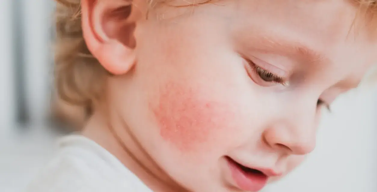 Rojo en la mejilla de un bebé, posible alergia a fruta, con síntomas visibles.