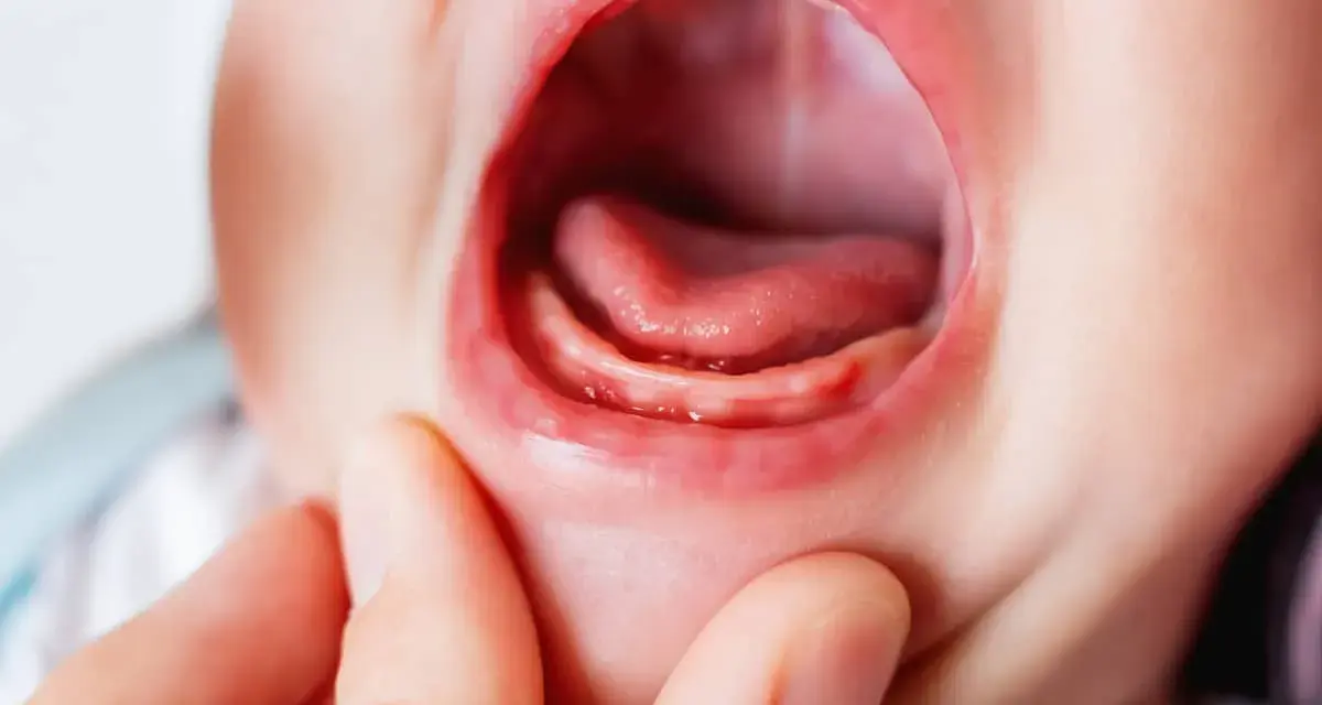 Boca de bebé con encías inflamadas y pequeños dientes asomando, indicando dolor encias bebe.