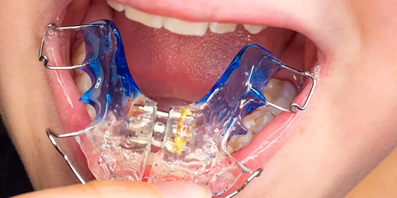 Boca de niño con aparato dental azul y transparente.