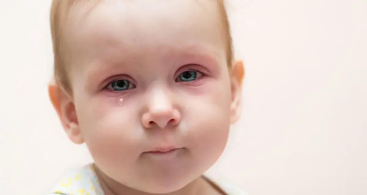 Bebé con ojos rojos e irritados, una lágrima cayendo, indicativo de conjuntivitis vírica.