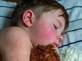 Niño durmiendo con mejillas rojas y erupción cutánea, síntomas de escarlatina en niños.