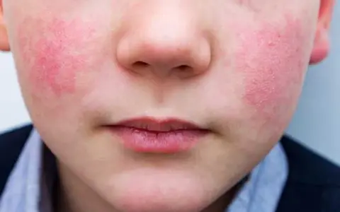 Primer plano de un niño con sarpullido alrededor de la boca y en las mejillas. La piel está enrojecida e irritada.