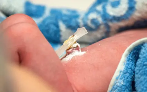 El cordón umbilical de un bebé, con un clip y polvo blanco, parece un ombligo con mal olor.