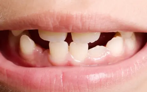 Boca de niño mostrando agenesia dental, con espacios donde faltan dientes.