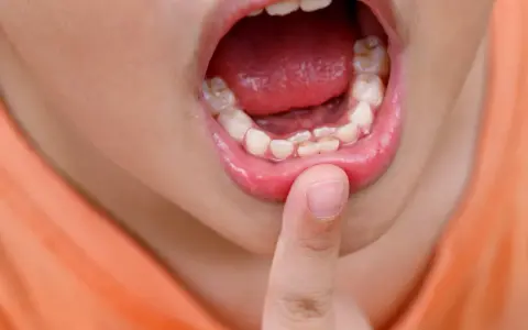 Boca de niño mostrando dientes irregulares, como dientes de tiburón en niños. Un dedo señala los dientes.