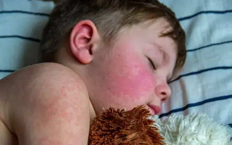 Niño durmiendo con mejillas rojas y erupción cutánea, síntomas de escarlatina en niños.