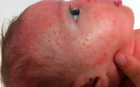 Bebé con sarpullido rojo y pequeños bultos en la cara y cabeza.