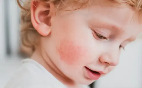 Rojo en la mejilla de un bebé, posible alergia a fruta, con síntomas visibles.