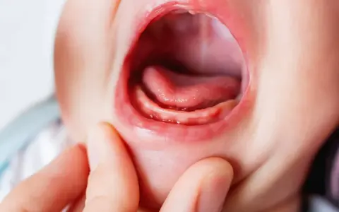 Boca de bebé con encías inflamadas y pequeños dientes asomando, indicando dolor encias bebe.