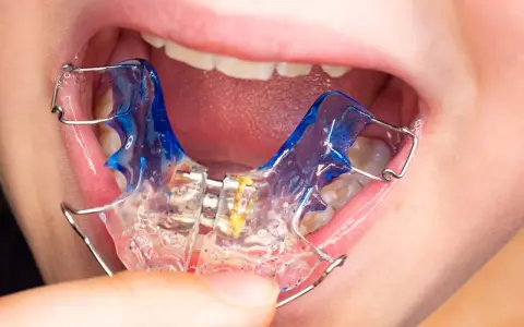 Boca de niño con aparato dental azul y transparente.