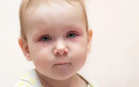 Bebé con ojos rojos e irritados, una lágrima cayendo, indicativo de conjuntivitis vírica.