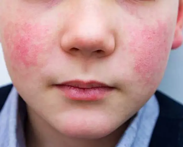 Primer plano de un niño con sarpullido alrededor de la boca y en las mejillas. La piel está enrojecida e irritada.