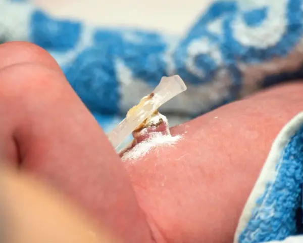 El cordón umbilical de un bebé, con un clip y polvo blanco, parece un ombligo con mal olor.