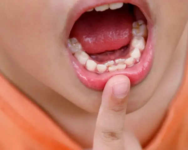 Boca de niño mostrando dientes irregulares, como dientes de tiburón en niños. Un dedo señala los dientes.