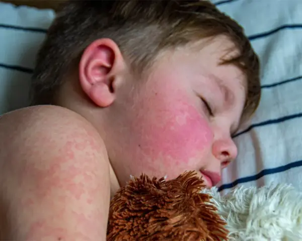 Niño durmiendo con mejillas rojas y erupción cutánea, síntomas de escarlatina en niños.