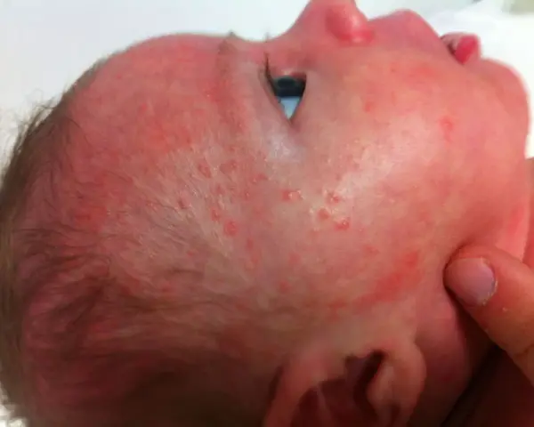 Bebé con sarpullido rojo y pequeños bultos en la cara y cabeza.