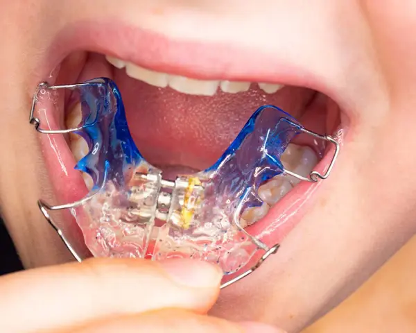 Boca de niño con aparato dental azul y transparente.