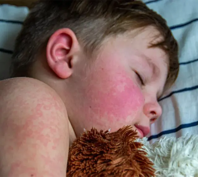 Niño durmiendo con mejillas rojas y erupción cutánea, síntomas de escarlatina en niños.