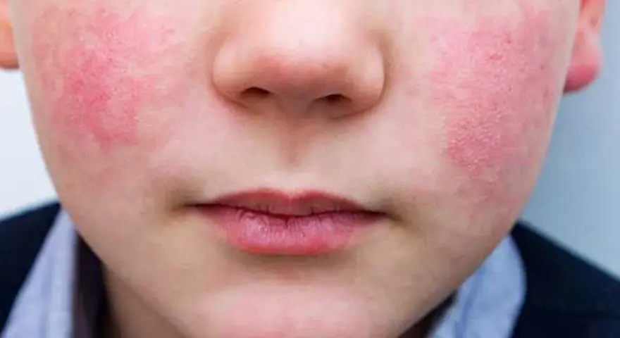 Primer plano de un niño con sarpullido alrededor de la boca y en las mejillas. La piel está enrojecida e irritada.