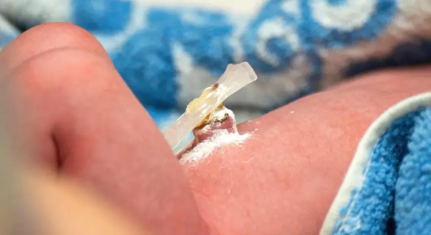 El cordón umbilical de un bebé, con un clip y polvo blanco, parece un ombligo con mal olor.