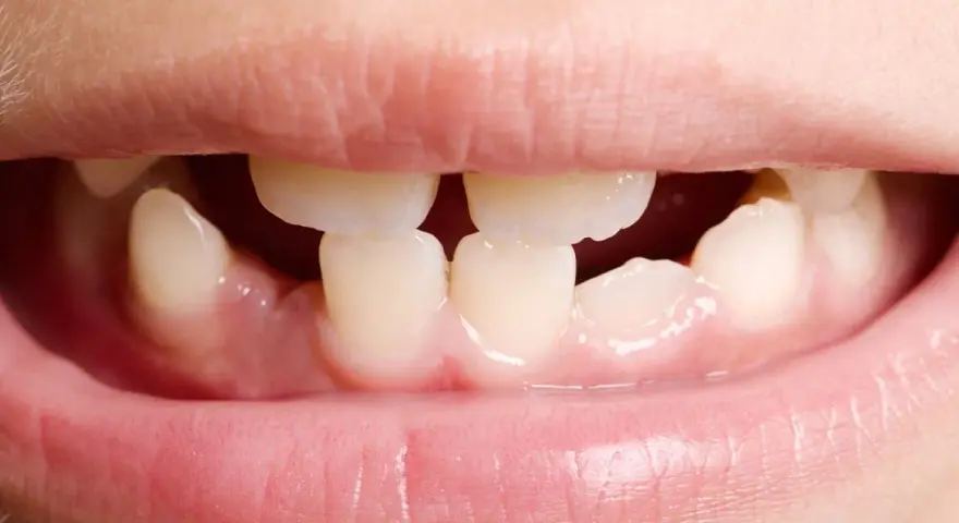 Boca de niño mostrando agenesia dental, con espacios donde faltan dientes.