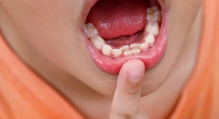 Boca de niño mostrando dientes irregulares, como dientes de tiburón en niños. Un dedo señala los dientes.