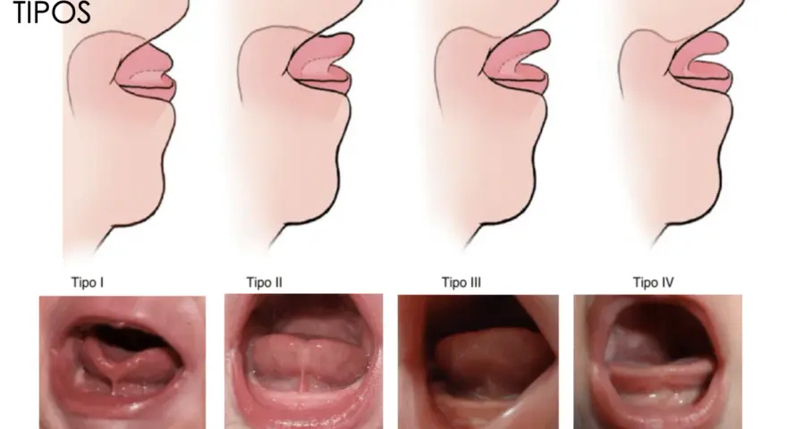 Ilustraciones y fotos de diferentes tipos de frenillo corto en bebés.