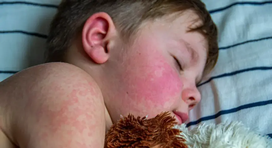 Niño durmiendo con mejillas rojas y erupción cutánea, síntomas de escarlatina en niños.