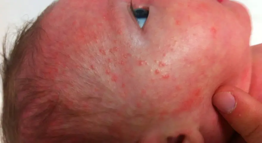 Bebé con sarpullido rojo y pequeños bultos en la cara y cabeza.