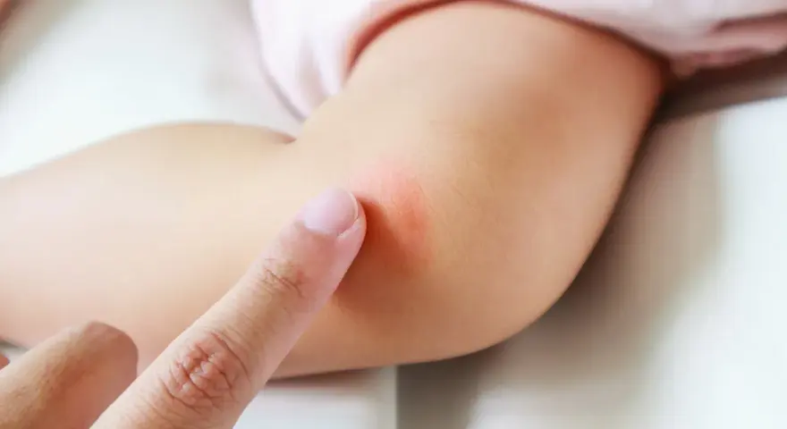 Dedo señala una marca roja en el brazo de un bebé. Es malo respirar antimosquitos eléctrico bebé.