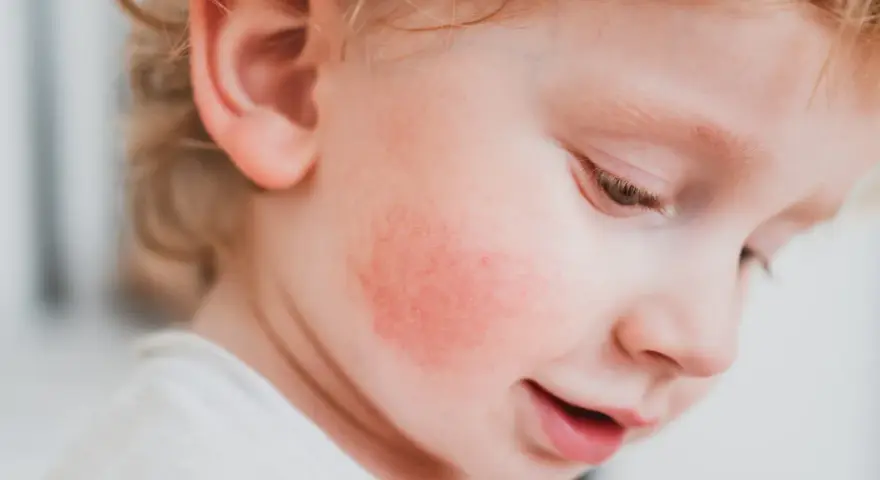 Rojo en la mejilla de un bebé, posible alergia a fruta, con síntomas visibles.