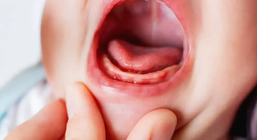 Boca de bebé con encías inflamadas y pequeños dientes asomando, indicando dolor encias bebe.